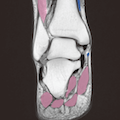 足関節MRI(冠状断像-右側)